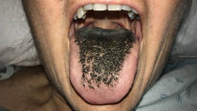 Why Does Pepto Bismol Cause Black Tongue? Full Explanation 2026