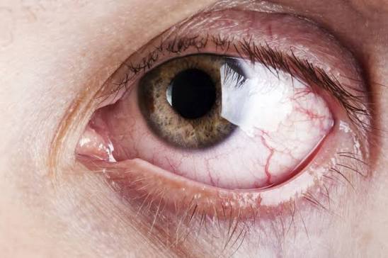 Why Do My Eyes Itch So Much? Causes & Fast Relief 2026