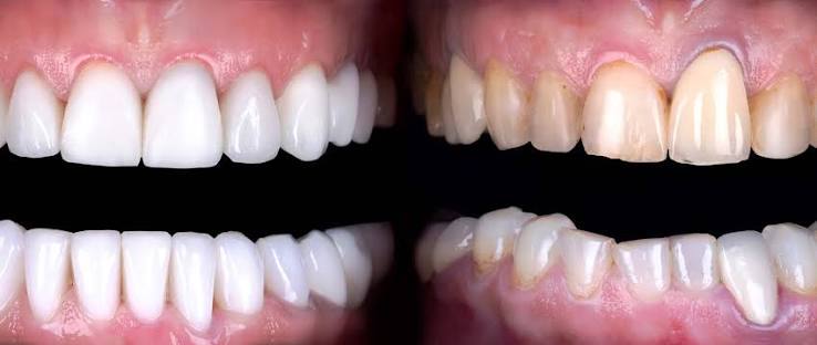 Why Veneers Are Bad: The Real Risks, Myths, and What to Know First 2026