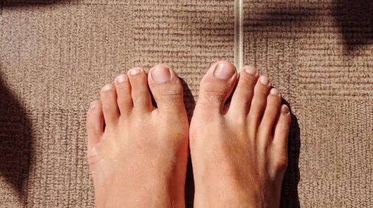 Why Are My Toenails Yellow? Causes, Remedies, and When to See a Doctor 2026
