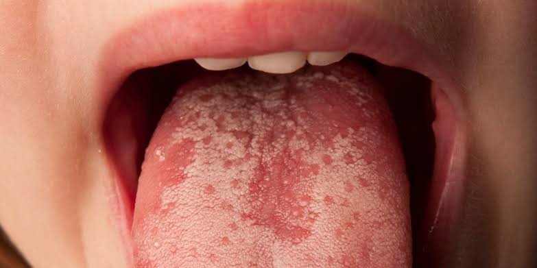 Why Do I Have a White Bump on My Tongue? Causes 2026