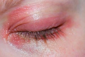 Why Are My Eyelids Red? 10 Causes, Home Remedies & When to See a Doctor