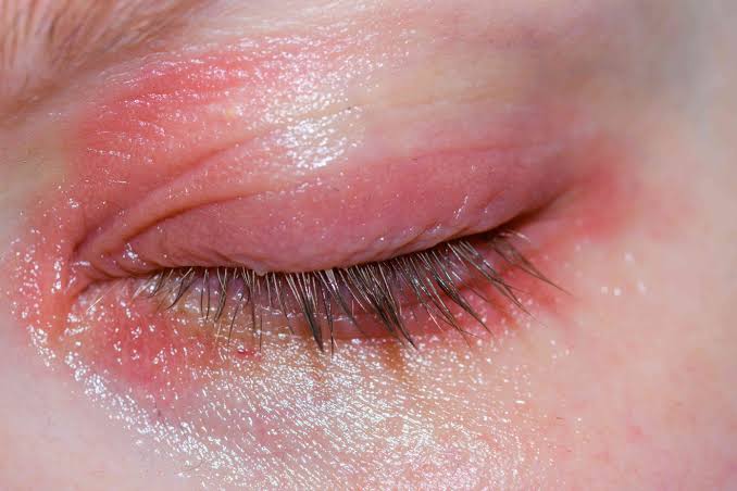 Why Are My Eyelids Red? 10 Causes, Home Remedies & When to See a Doctor