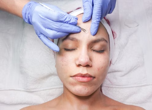 The Benefits of Professional Acne Facials for Blemish-Prone Skin